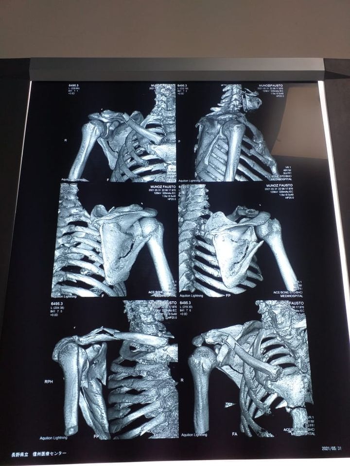 El omóplato tiene completamente destrozado.