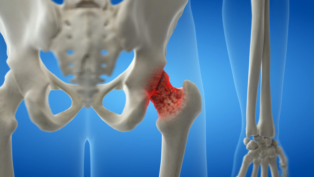 El 20 de octubre de 1996, la Sociedad Nacional de Osteoporosis de Gran Bretaña, lanzó una campaña destinada a prevenir la enfermedad y a concienciar a la población sobre su diagnóstico y tratamiento. (Imagen: gestarsalud.com)