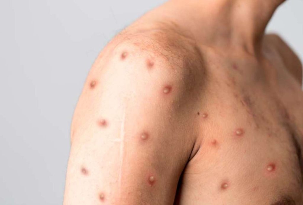 Funcionaria afirma que no hay complicación en los casos presentados.