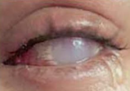 La córnea del ojo derecho está quemada y la derecha tratan de salvarla. (fotografía referencial)